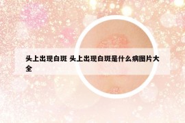 头上出现白斑 头上出现白斑是什么病图片大全