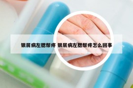 银屑病左腮帮疼 银屑病左腮帮疼怎么回事