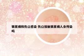 银屑病和伤口感染 伤口接触银屑病人会传染吗