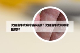 沈阳治牛皮癣享南风超好 沈阳治牛皮屑哪家医院好