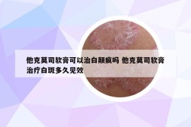 他克莫司软膏可以治白颠疯吗 他克莫司软膏治疗白斑多久见效