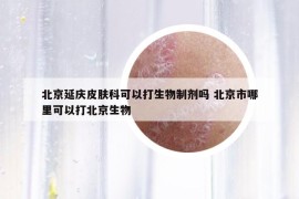 北京延庆皮肤科可以打生物制剂吗 北京市哪里可以打北京生物