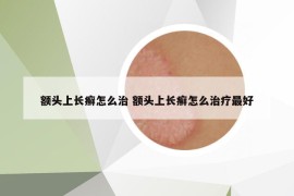 额头上长癣怎么治 额头上长癣怎么治疗最好