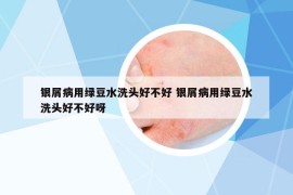 银屑病用绿豆水洗头好不好 银屑病用绿豆水洗头好不好呀