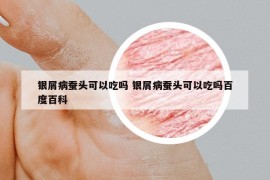 银屑病蚕头可以吃吗 银屑病蚕头可以吃吗百度百科