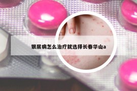 银屑病怎么治疗就选择长春华山a