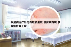 银屑病治疗出现白斑和黑斑 银屑病白斑 多久能恢复正常