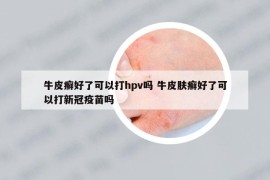 牛皮癣好了可以打hpv吗 牛皮肤癣好了可以打新冠疫苗吗