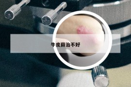 牛皮藓治不好