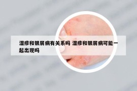 湿疹和银屑病有关系吗 湿疹和银屑病可能一起出现吗