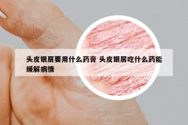 头皮银屑要用什么药膏 头皮银屑吃什么药能缓解病情