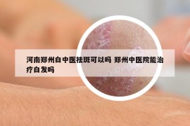 河南郑州白中医祛斑可以吗 郑州中医院能治疗白发吗