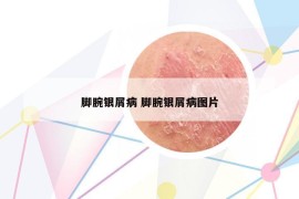 脚腕银屑病 脚腕银屑病图片