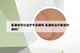 氟康唑可以治疗牛皮癣吗 氟康唑治疗癣有作用吗?