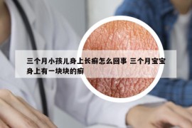 三个月小孩儿身上长癣怎么回事 三个月宝宝身上有一块块的癣