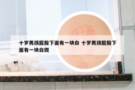 十岁男孩屁股下面有一块白 十岁男孩屁股下面有一块白斑