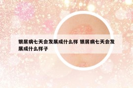 银屑病七天会发展成什么样 银屑病七天会发展成什么样子