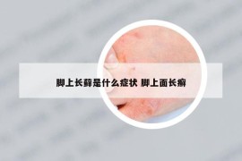 脚上长藓是什么症状 脚上面长癣