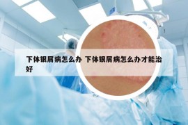 下体银屑病怎么办 下体银屑病怎么办才能治好