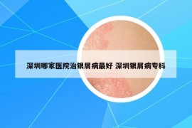 深圳哪家医院治银屑病最好 深圳银屑病专科