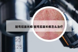 腿弯后面长癣 腿弯后面长癣怎么治疗