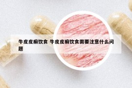 牛皮皮癣饮食 牛皮皮癣饮食需要注意什么问题