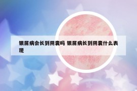 银屑病会长到阴囊吗 银屑病长到阴囊什么表现