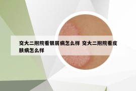 交大二附院看银屑病怎么样 交大二附院看皮肤病怎么样