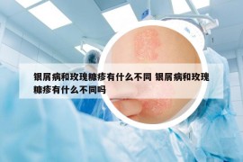 银屑病和玫瑰糠疹有什么不同 银屑病和玫瑰糠疹有什么不同吗