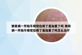 银屑病一开始不痒现在痒了是加重了吗 银屑病一开始不痒现在痒了是加重了吗怎么治疗