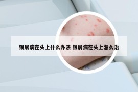 银屑病在头上什么办法 银屑病在头上怎么治