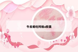 牛皮癣吃阿维a胶囊