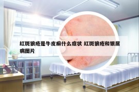 红斑狼疮是牛皮癣什么症状 红斑狼疮和银屑病图片