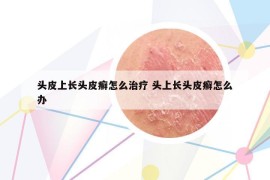 头皮上长头皮癣怎么治疗 头上长头皮癣怎么办