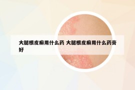 大腿根皮癣用什么药 大腿根皮癣用什么药膏好