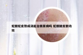 蛇胆蛇皮熬成汤能治银屑病吗 蛇胆陂皮散功效