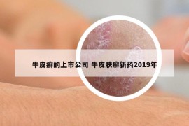 牛皮癣的上市公司 牛皮肤癣新药2019年