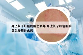 身上长了红色的癣怎么办 身上长了红色的癣怎么办用什么药