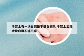 手臂上有一块白斑是不是白癜风 手臂上出现大块白斑不痛不痒