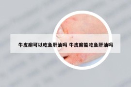 牛皮癣可以吃鱼肝油吗 牛皮廨能吃鱼肝油吗