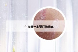 牛皮癣一定要打激光么