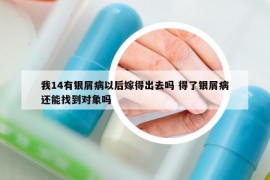 我14有银屑病以后嫁得出去吗 得了银屑病还能找到对象吗