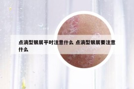 点滴型银屑平时注意什么 点滴型银屑要注意什么