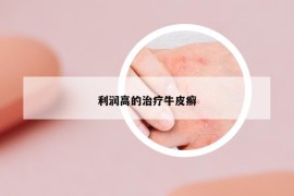 利润高的治疗牛皮癣