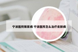 宁波医院银屑病 宁波医院怎么治疗皮肤病