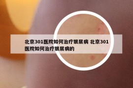 北京301医院如何治疗银屑病 北京301医院如何治疗银屑病的