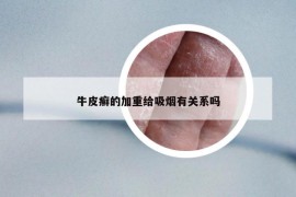 牛皮癣的加重给吸烟有关系吗