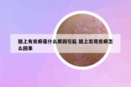 腿上有皮癣是什么原因引起 腿上出现皮癣怎么回事