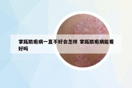 掌跖脓疱病一直不好会怎样 掌跖脓疱病能看好吗