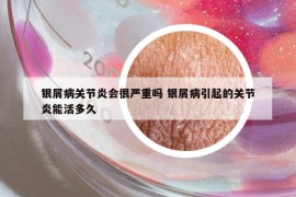 银屑病关节炎会很严重吗 银屑病引起的关节炎能活多久